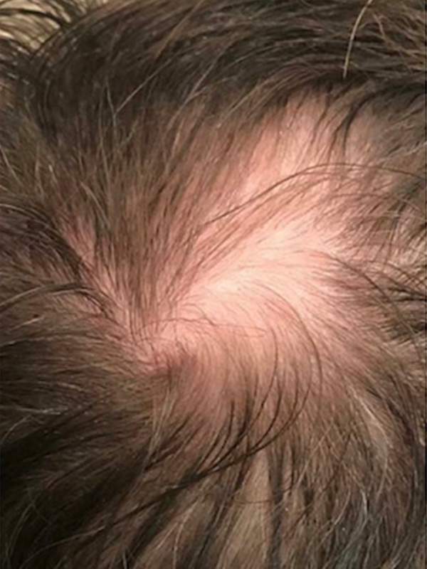 Keralase Hair Restoration with the Lutronic Ultra Laser Before & After Gallery - Patient 122707622 - Image 1