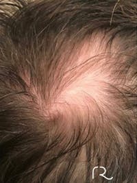 Keralase Hair Restoration with the Lutronic Ultra Laser Before & After Gallery - Patient 122707622 - Image 1