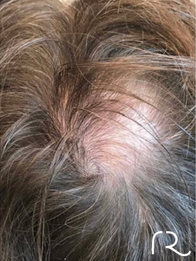 Keralase Hair Restoration with the Lutronic Ultra Laser Gallery - Patient 122707622 - Image 2