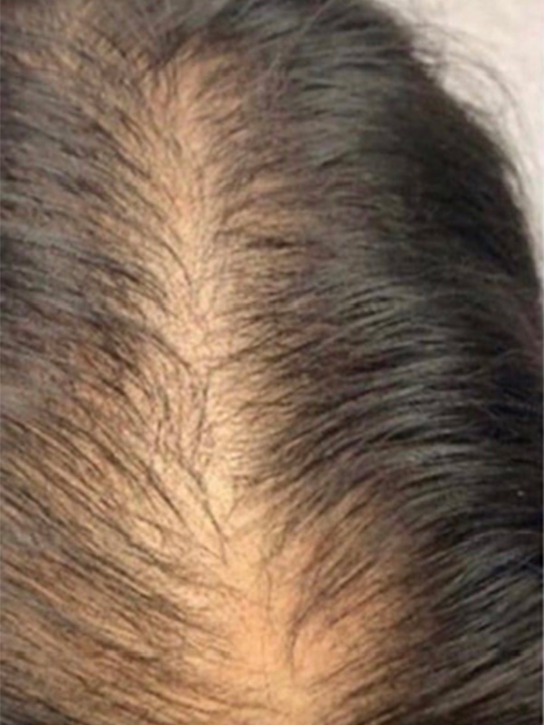 Keralase Hair Restoration with the Lutronic Ultra Laser Before & After Gallery - Patient 122707623 - Image 1