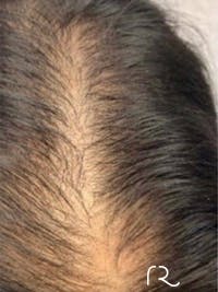 Keralase Hair Restoration with the Lutronic Ultra Laser Before & After Gallery - Patient 122707623 - Image 1