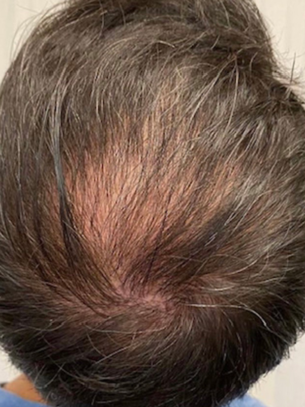 Keralase Hair Restoration with the Lutronic Ultra Laser Before & After Gallery - Patient 122707624 - Image 1