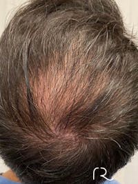 Keralase Hair Restoration with the Lutronic Ultra Laser Before & After Gallery - Patient 122707624 - Image 1