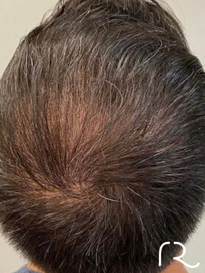 Keralase Hair Restoration with the Lutronic Ultra Laser Before & After Gallery - Patient 122707624 - Image 2