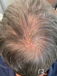 Keralase Hair Restoration with the Lutronic Ultra Laser Before & After Gallery - Patient 122707625 - Image 1