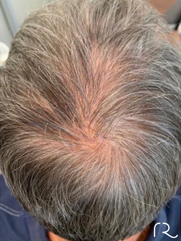 Keralase Hair Restoration with the Lutronic Ultra Laser Before & After Gallery - Patient 122707625 - Image 1
