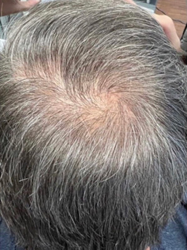 Keralase Hair Restoration with the Lutronic Ultra Laser Before & After Gallery - Patient 122707625 - Image 2