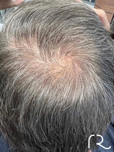 Keralase Hair Restoration with the Lutronic Ultra Laser Before & After Gallery - Patient 122707625 - Image 2