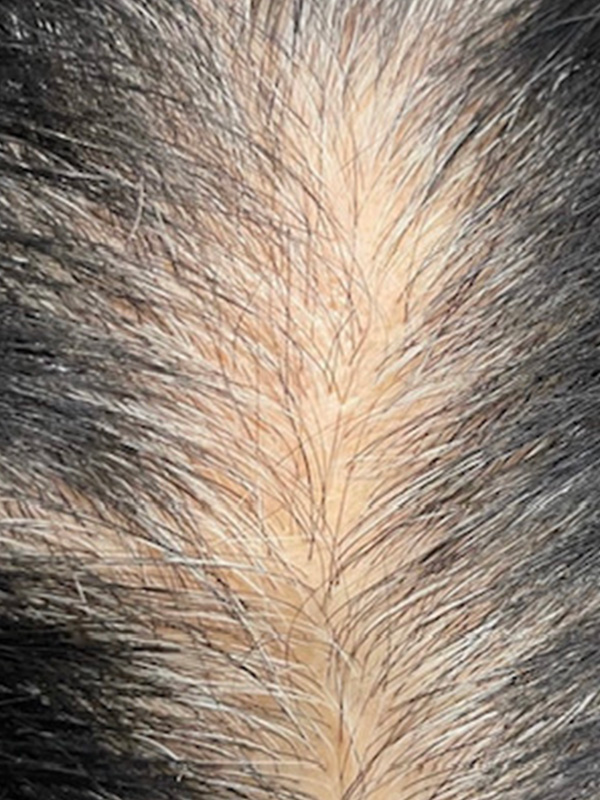 Keralase Hair Restoration with the Lutronic Ultra Laser Before & After Gallery - Patient 122707626 - Image 1
