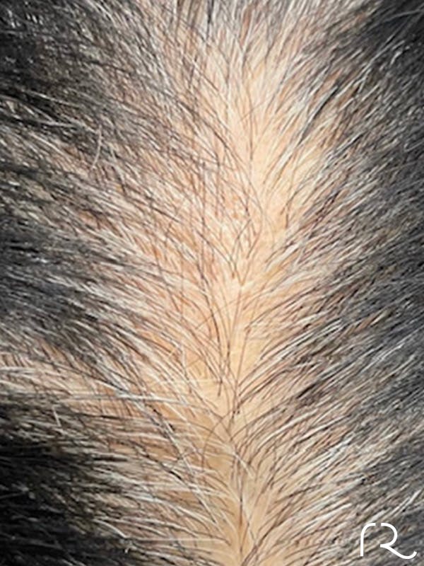 Keralase Hair Restoration with the Lutronic Ultra Laser Gallery - Patient 122707626 - Image 1