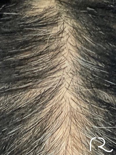 Keralase Hair Restoration with the Lutronic Ultra Laser Before & After Gallery - Patient 122707626 - Image 2