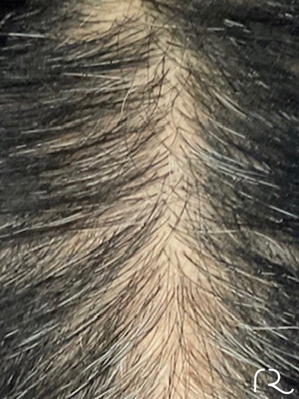 Keralase Hair Restoration with the Lutronic Ultra Laser Gallery - Patient 122707626 - Image 2