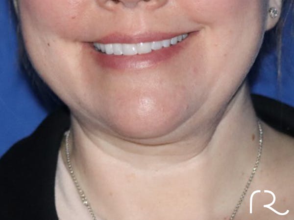 Neck Liposuction  Before & After Gallery - Patient 122707662 - Image 1