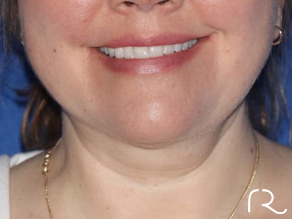 Neck Liposuction  Before & After Gallery - Patient 122707662 - Image 2