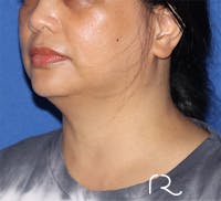 Neck Liposuction  Before & After Gallery - Patient 141203208 - Image 1