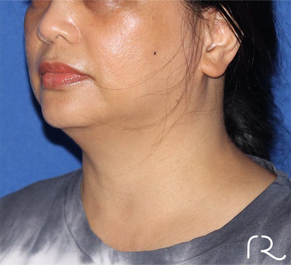 Neck Liposuction  Before & After Gallery - Patient 141203208 - Image 1