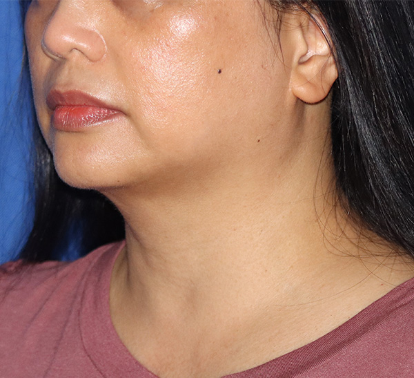 Neck Liposuction  Before & After Gallery - Patient 141203208 - Image 2
