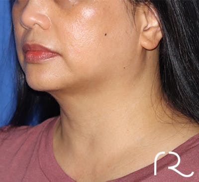 Neck Liposuction  Before & After Gallery - Patient 141203208 - Image 2