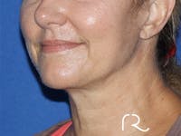 Neck Lift Before & After Gallery - Patient 141494264 - Image 1