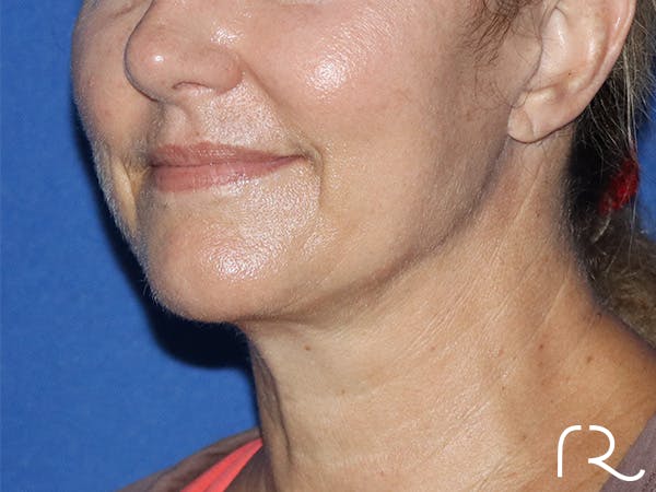 Facelift Before & After Gallery - Patient 141493958 - Image 1