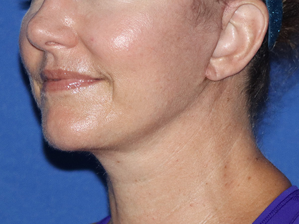 Neck Lift Before & After Gallery - Patient 141494264 - Image 2