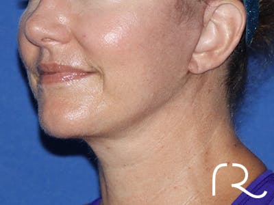 Neck Lift Before & After Gallery - Patient 141494264 - Image 2