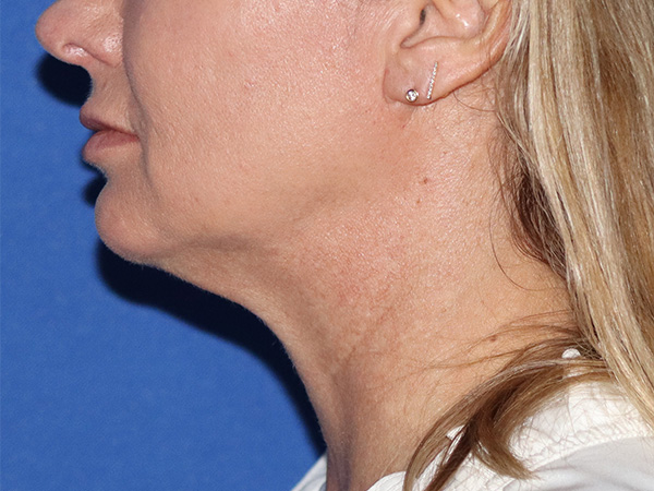 Neck Lift Before & After Gallery - Patient 141494263 - Image 1