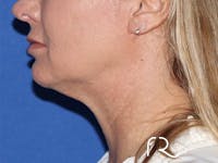 Neck Lift Before & After Gallery - Patient 141494263 - Image 1
