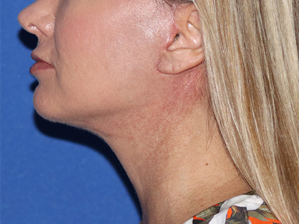Neck Lift Before & After Gallery - Patient 141494263 - Image 2