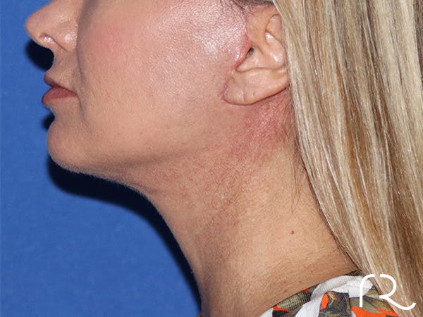 Neck Lift Before & After Gallery - Patient 141494263 - Image 2
