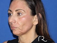 Facelift Before & After Gallery - Patient 141493967 - Image 1