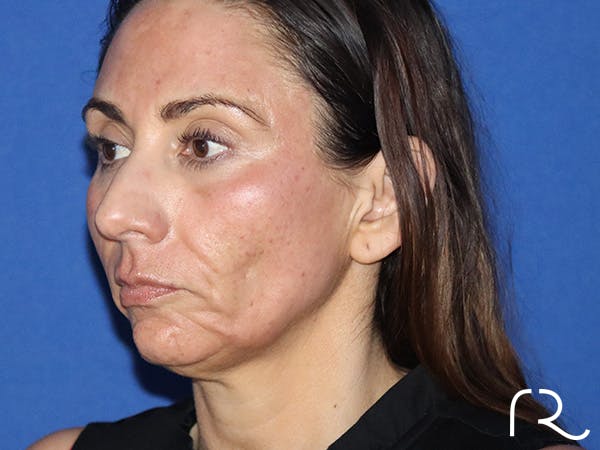 Facelift Before & After Gallery - Patient 141493967 - Image 1