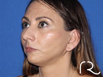 Facelift Before & After Gallery - Patient 141493967 - Image 2