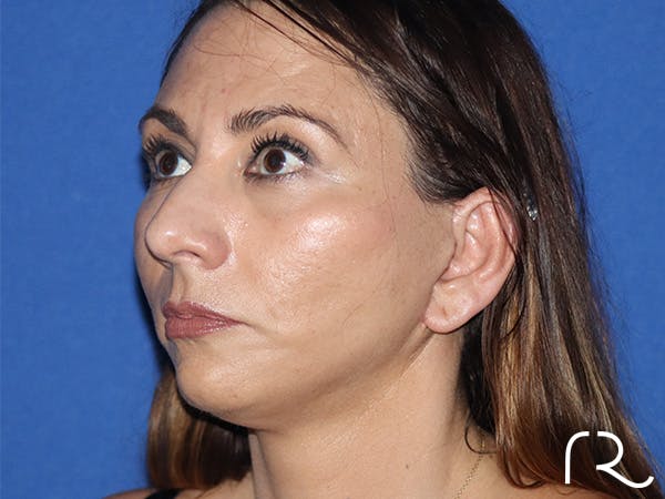 Neck Lift Before & After Gallery - Patient 141494262 - Image 2