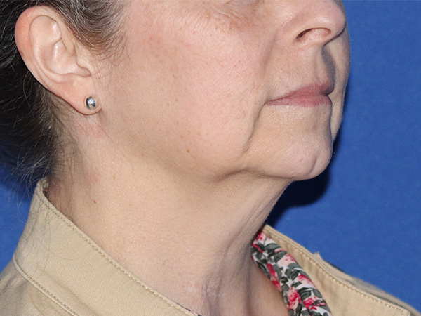 Neck Lift Before & After Gallery - Patient 141494261 - Image 1