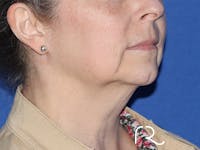 Facelift Before & After Gallery - Patient 141493968 - Image 1