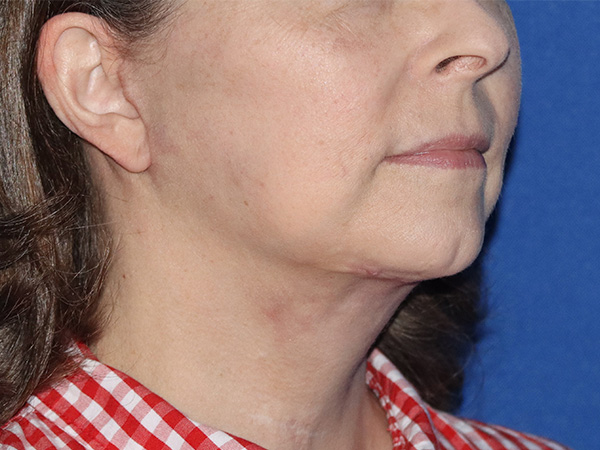 Neck Lift Before & After Gallery - Patient 141494261 - Image 2