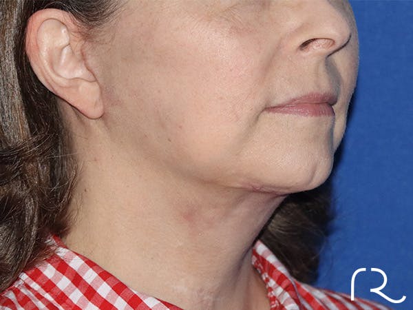 Neck Lift Before & After Gallery - Patient 141494261 - Image 2