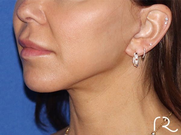 Facelift Before & After Gallery - Patient 141493966 - Image 2