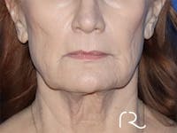 Facelift Before & After Gallery - Patient 141493964 - Image 1