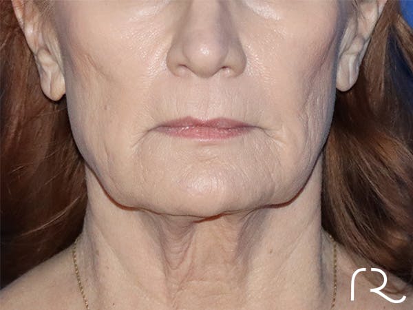 Neck Lift Before & After Gallery - Patient 141494259 - Image 1