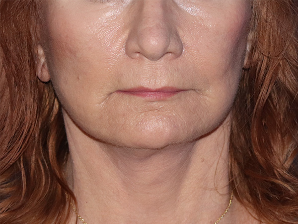 Facelift Before & After Gallery - Patient 141493964 - Image 2