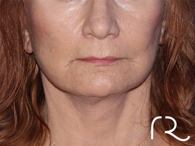 Facelift Before & After Gallery - Patient 141493964 - Image 2