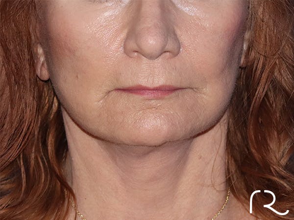 Neck Lift Before & After Gallery - Patient 141494259 - Image 2