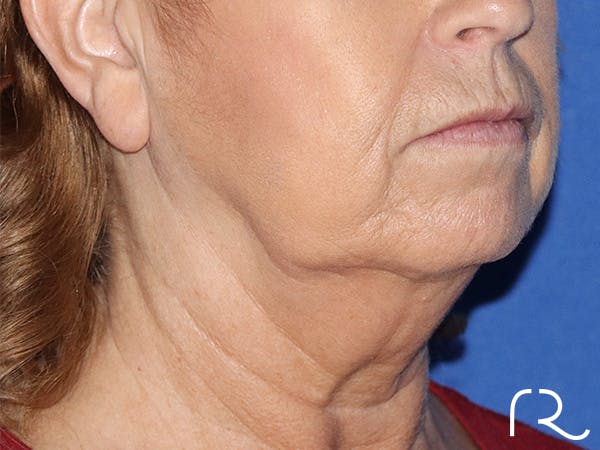 Neck Lift Before & After Gallery - Patient 141494258 - Image 1