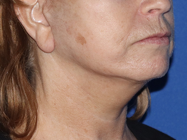 Neck Lift Before & After Gallery - Patient 141494258 - Image 2