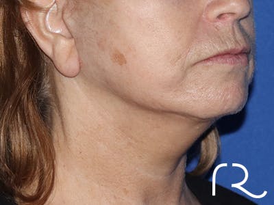 Facelift Before & After Gallery - Patient 141493965 - Image 2