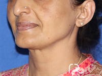 Facelift Before & After Gallery - Patient 141493962 - Image 1