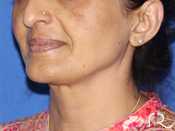 Neck Lift Before & After Gallery - Patient 141494257 - Image 1