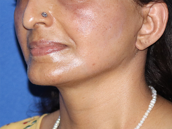 Neck Lift Before & After Gallery - Patient 141494257 - Image 2